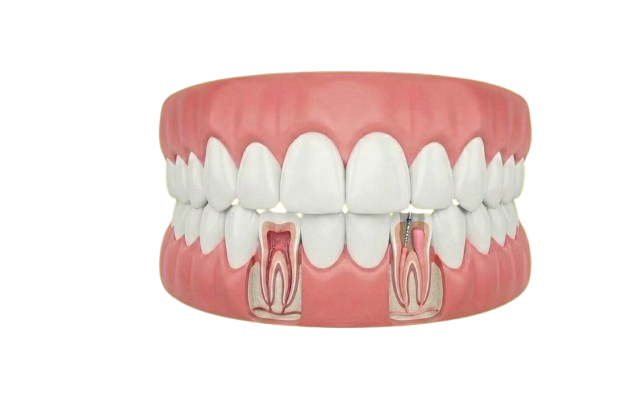Root Canal
